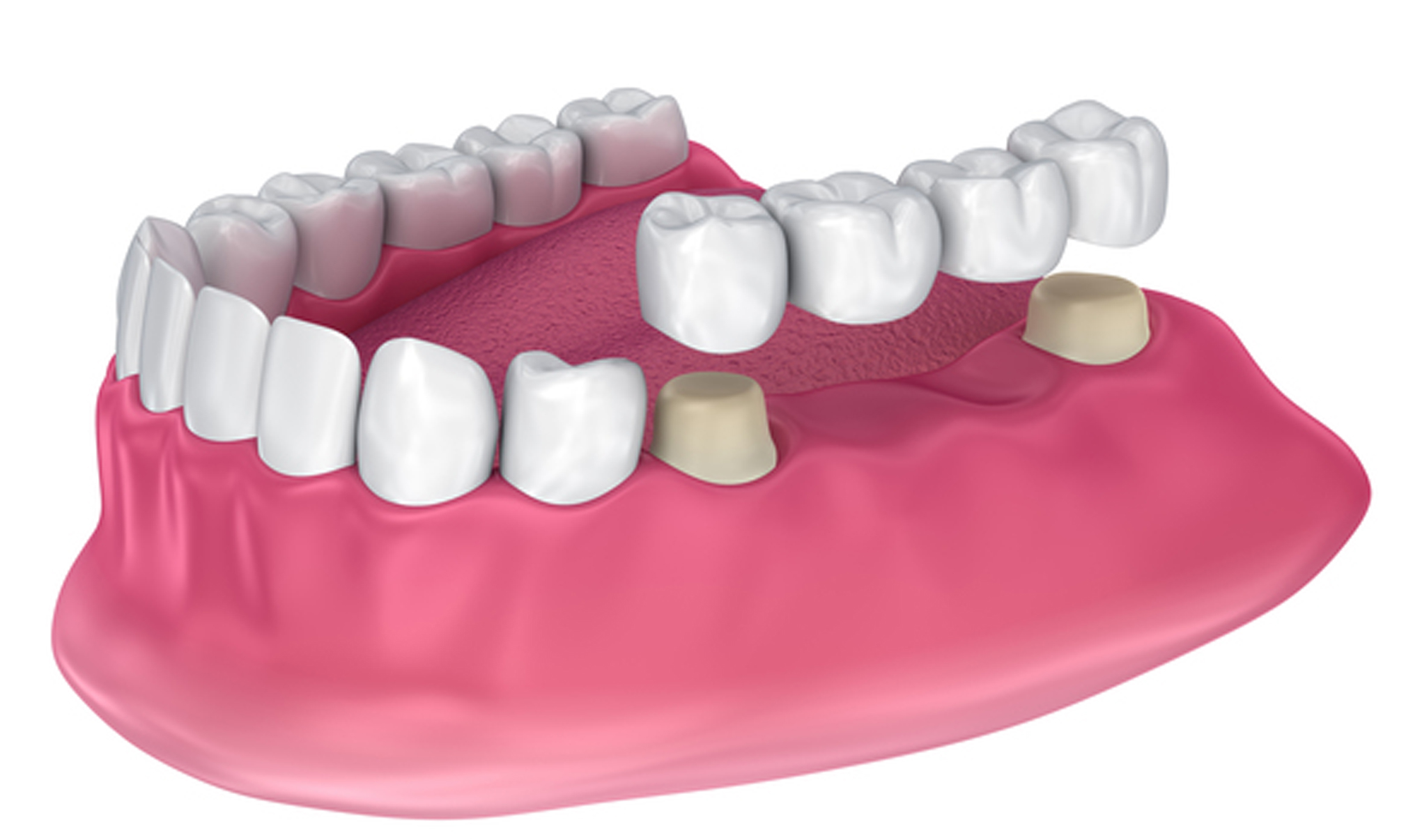 Dental Bridges