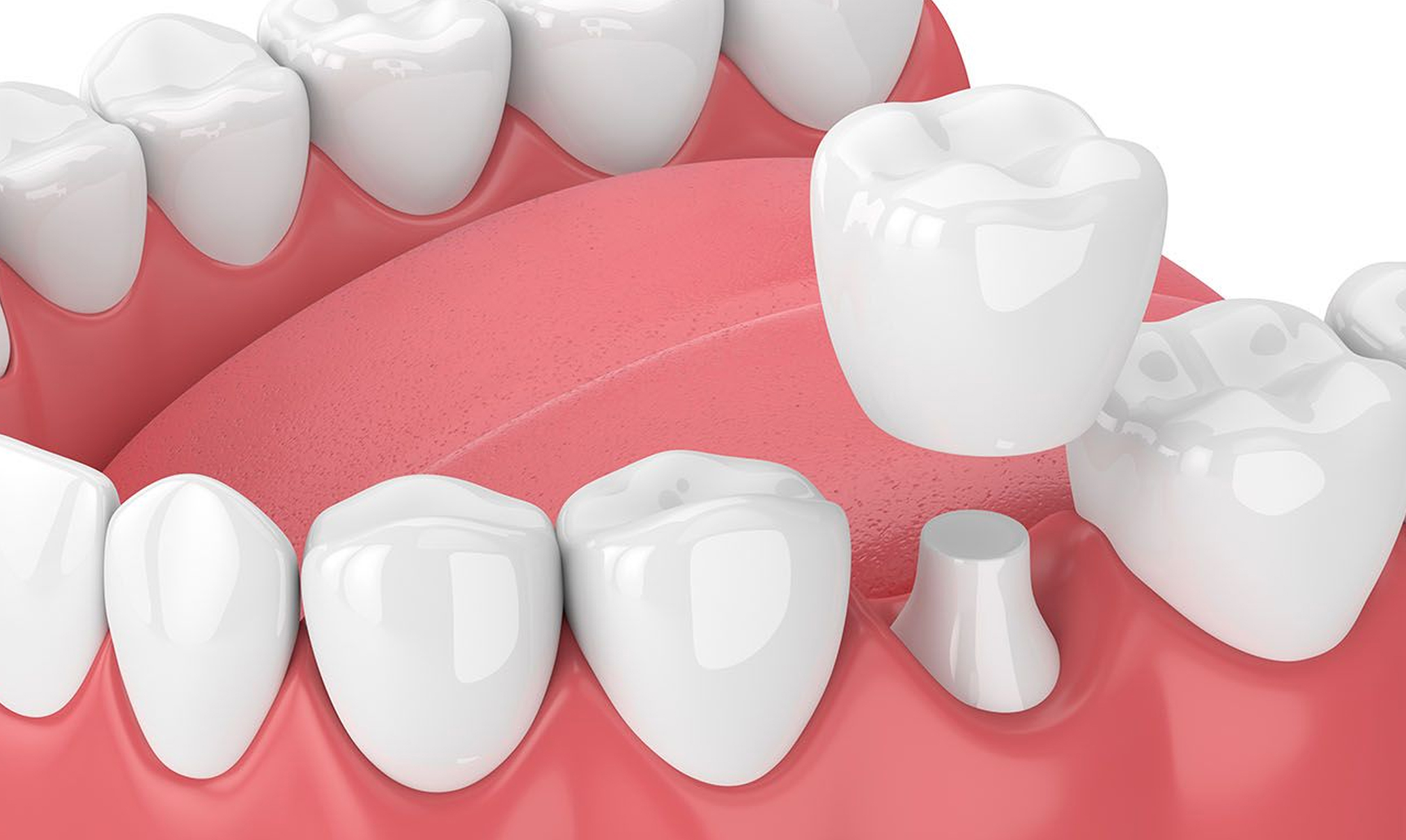 Dental Crowns