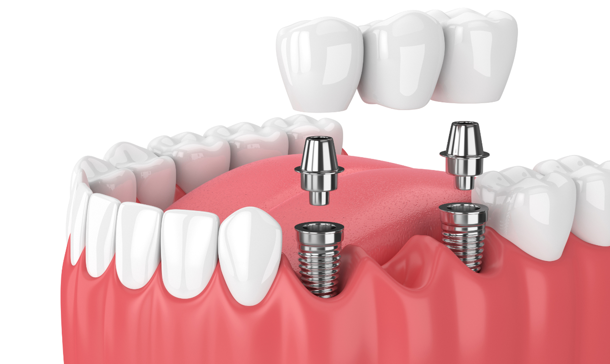 Dental Implants