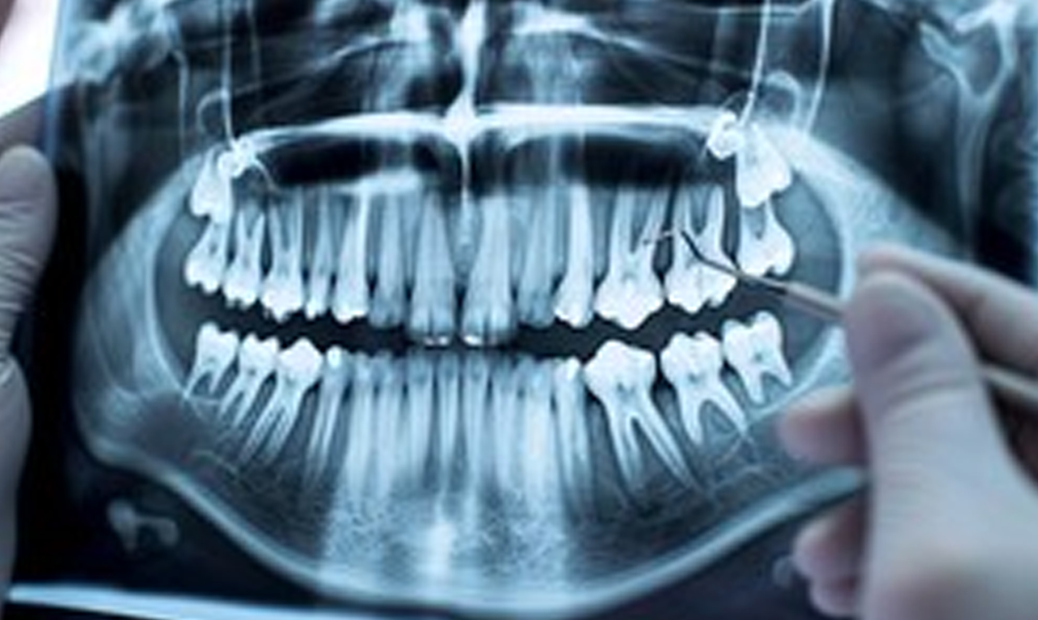 Full Mouth X-Ray