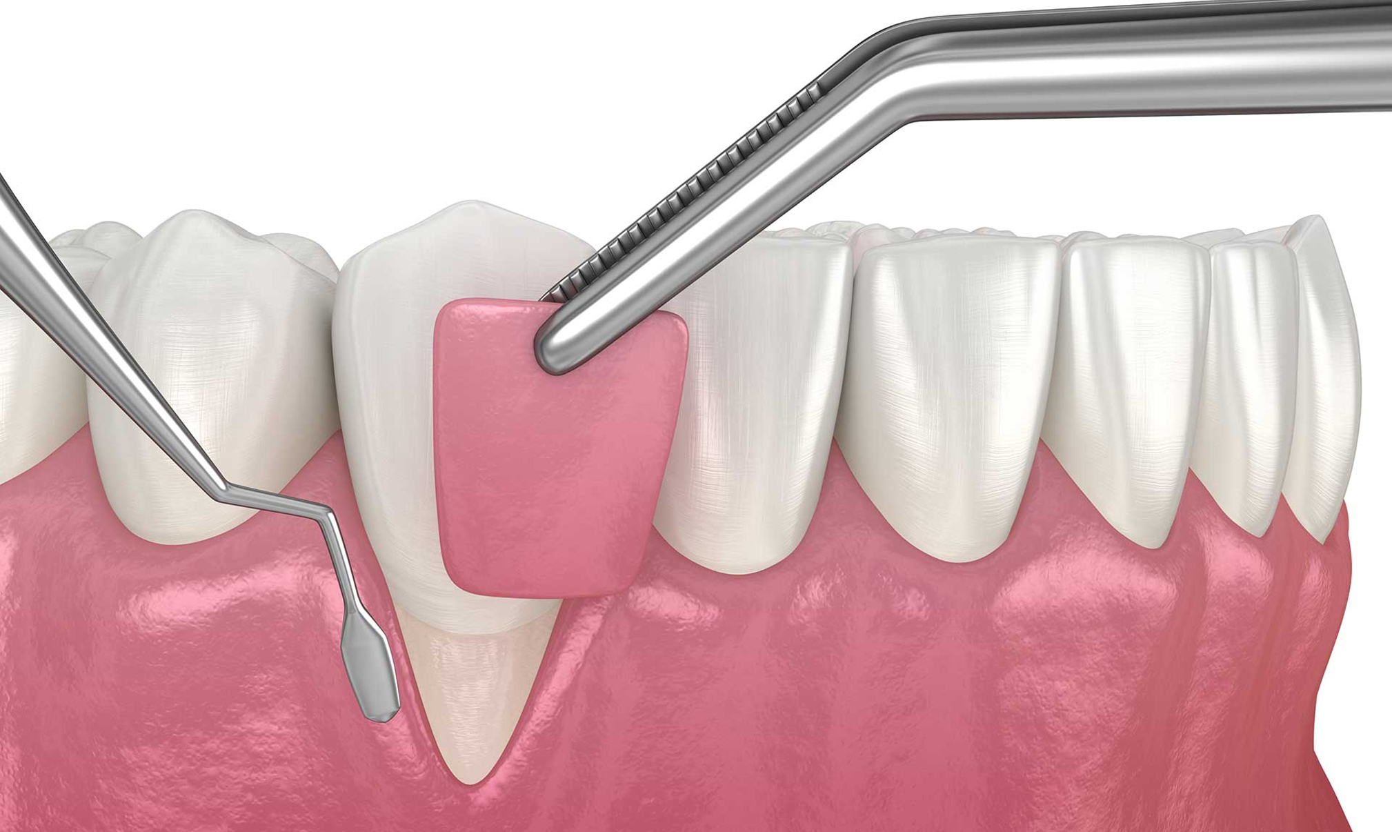 Gum Surgery