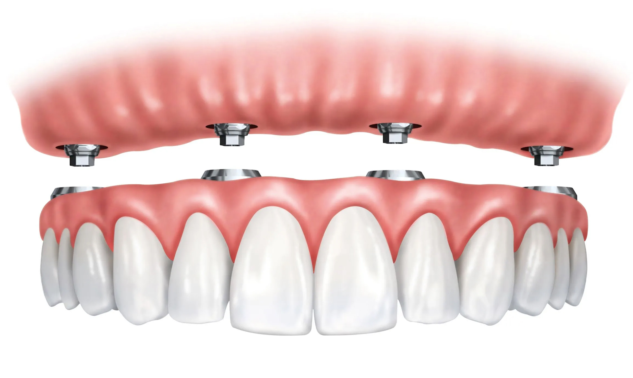 Hybrid Dentures