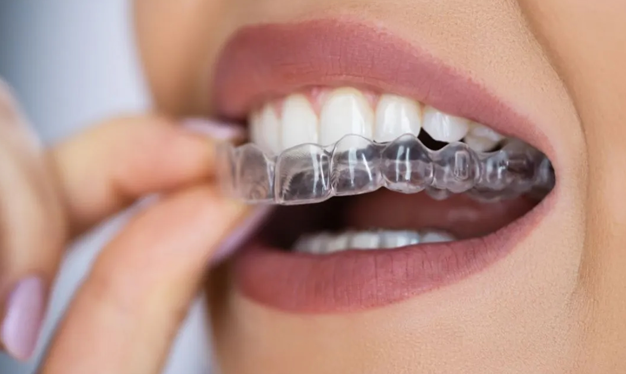 Invisible Braces & Aligners