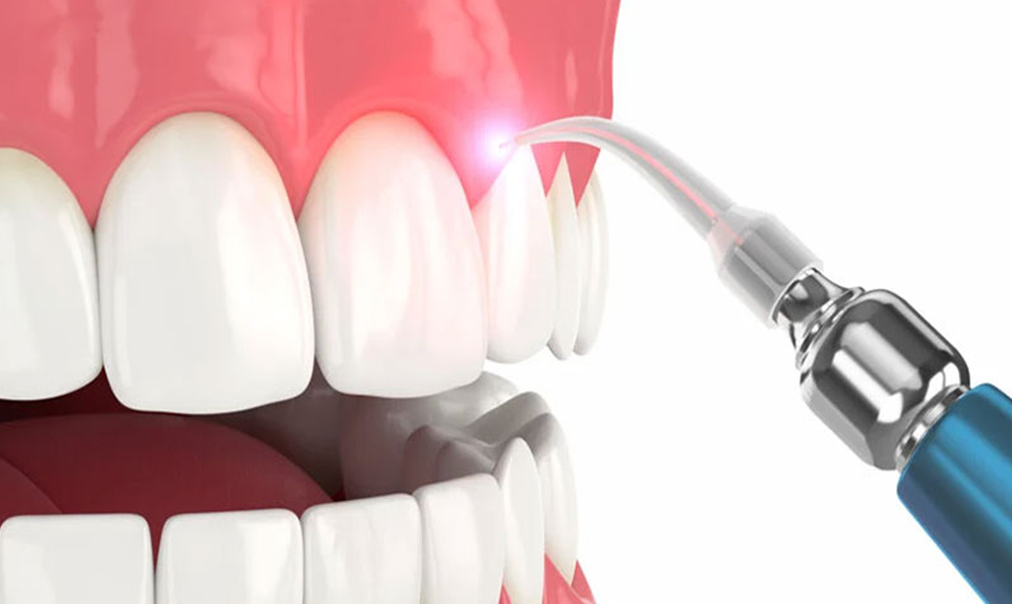 Laser Dentistry