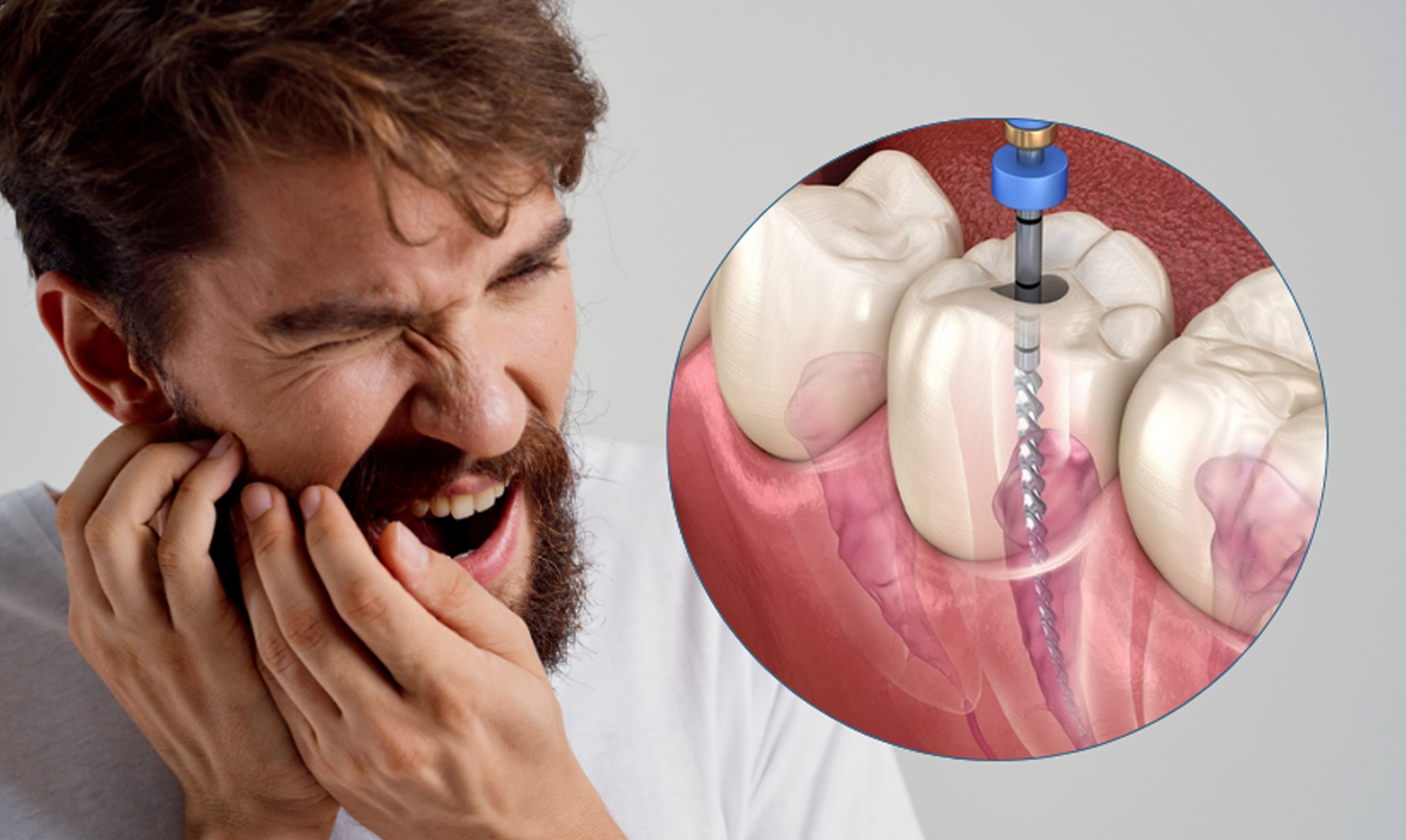 Root Canal Treatment