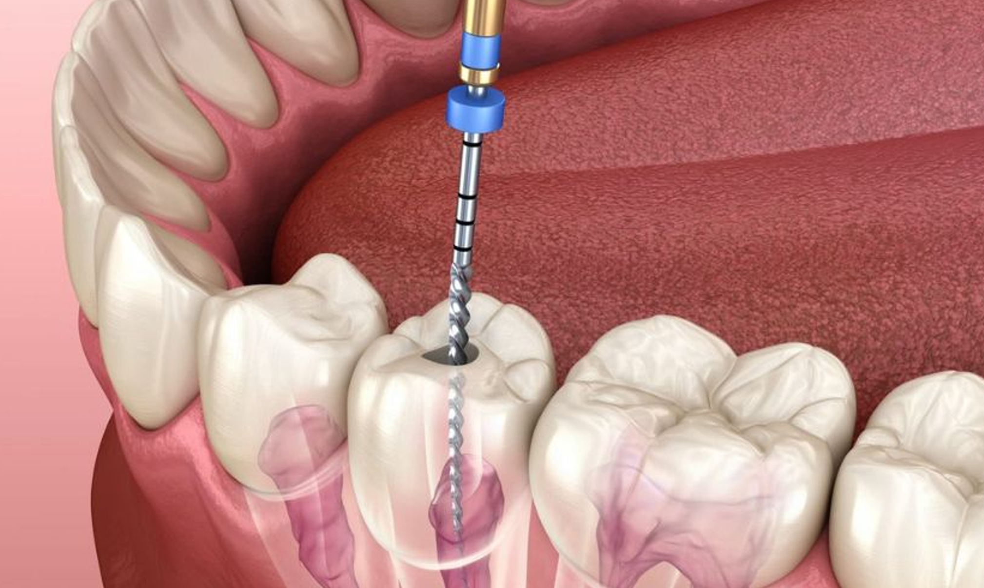 Single Sitting Root Canal