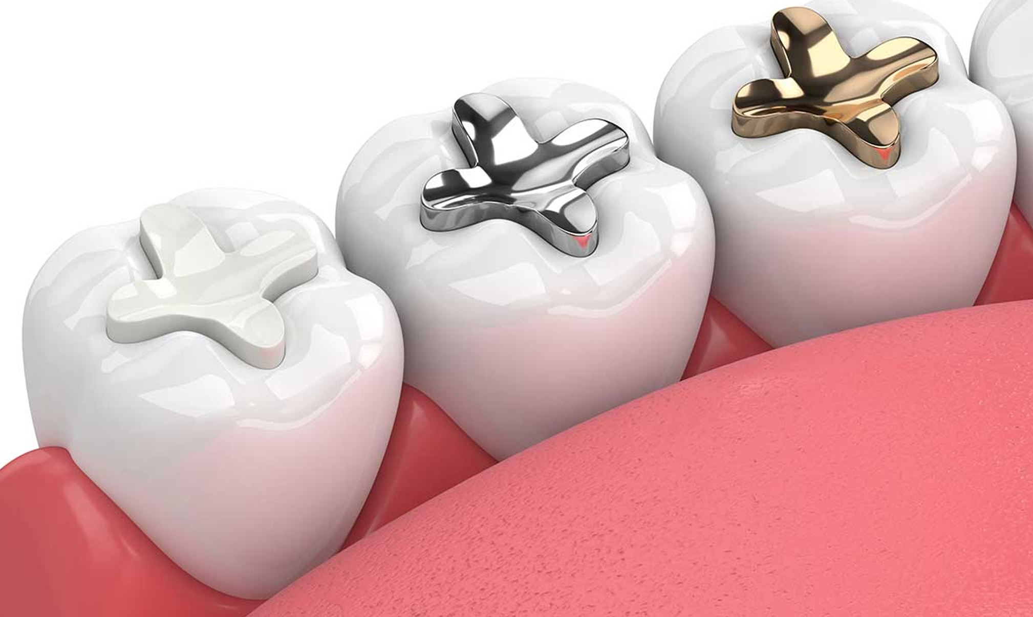 Tooth Coloured Fillings