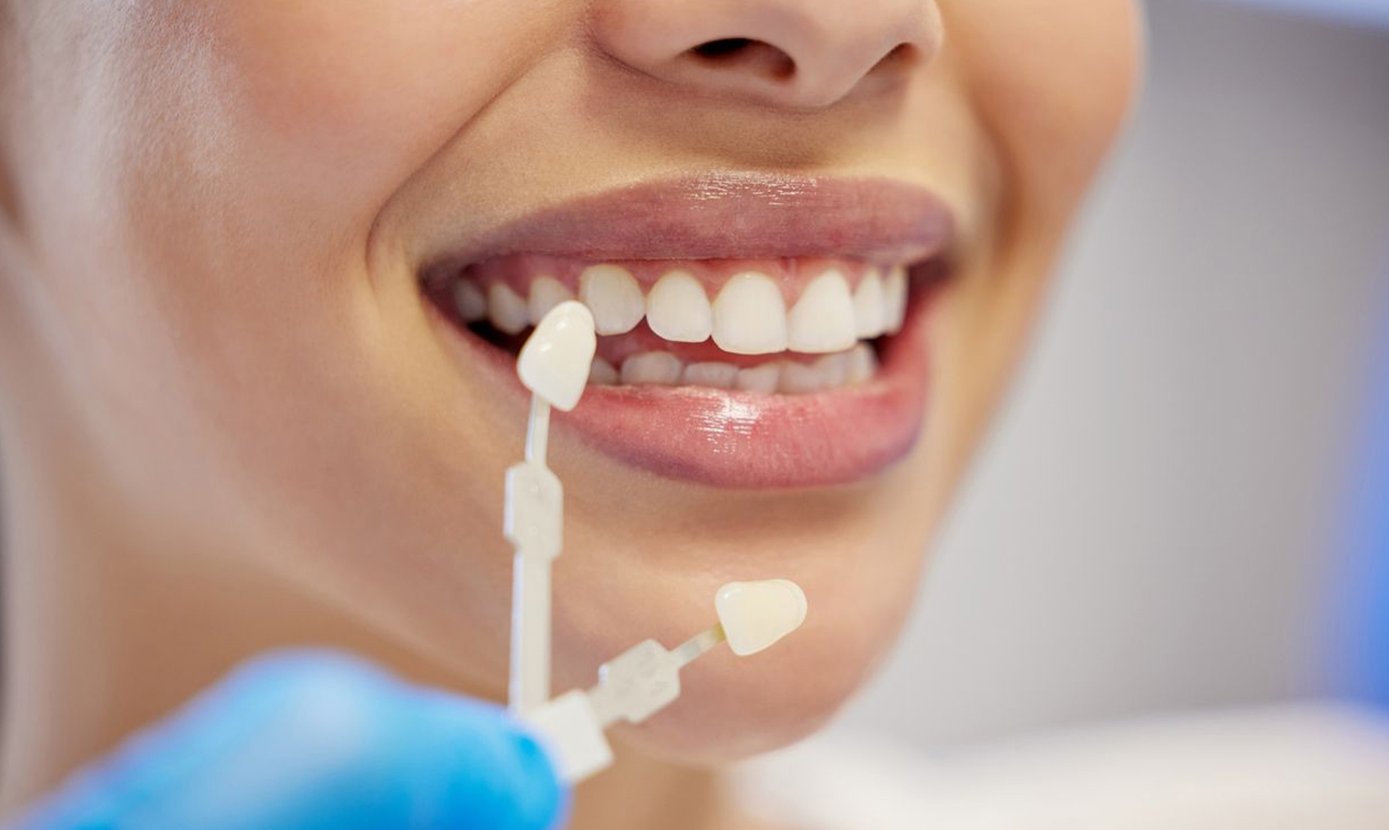Veneers