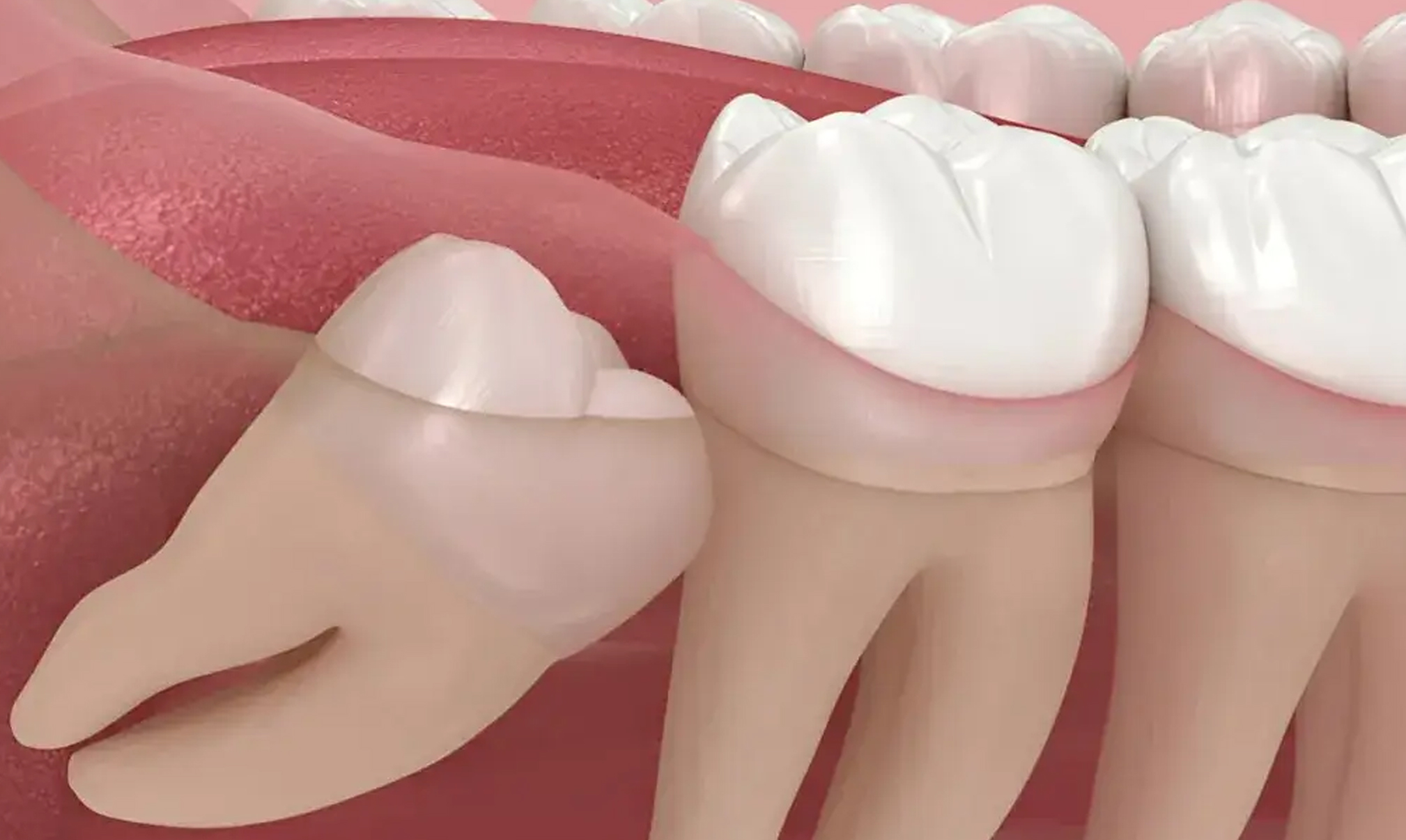 Wisdom Tooth Extraction