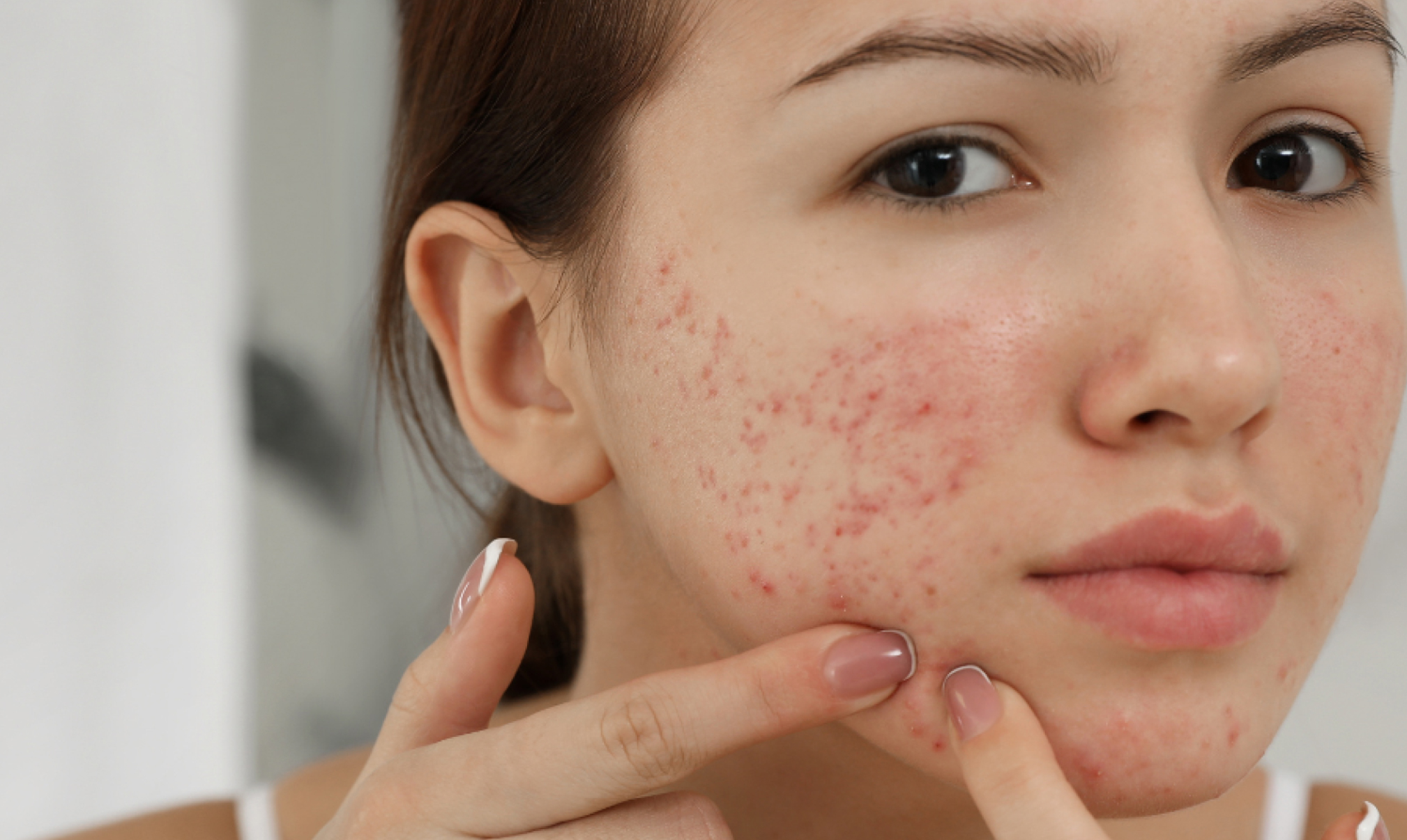 Acne Treatment