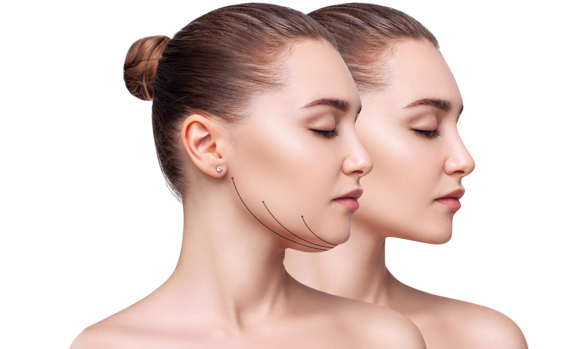 Double Chin Treatment