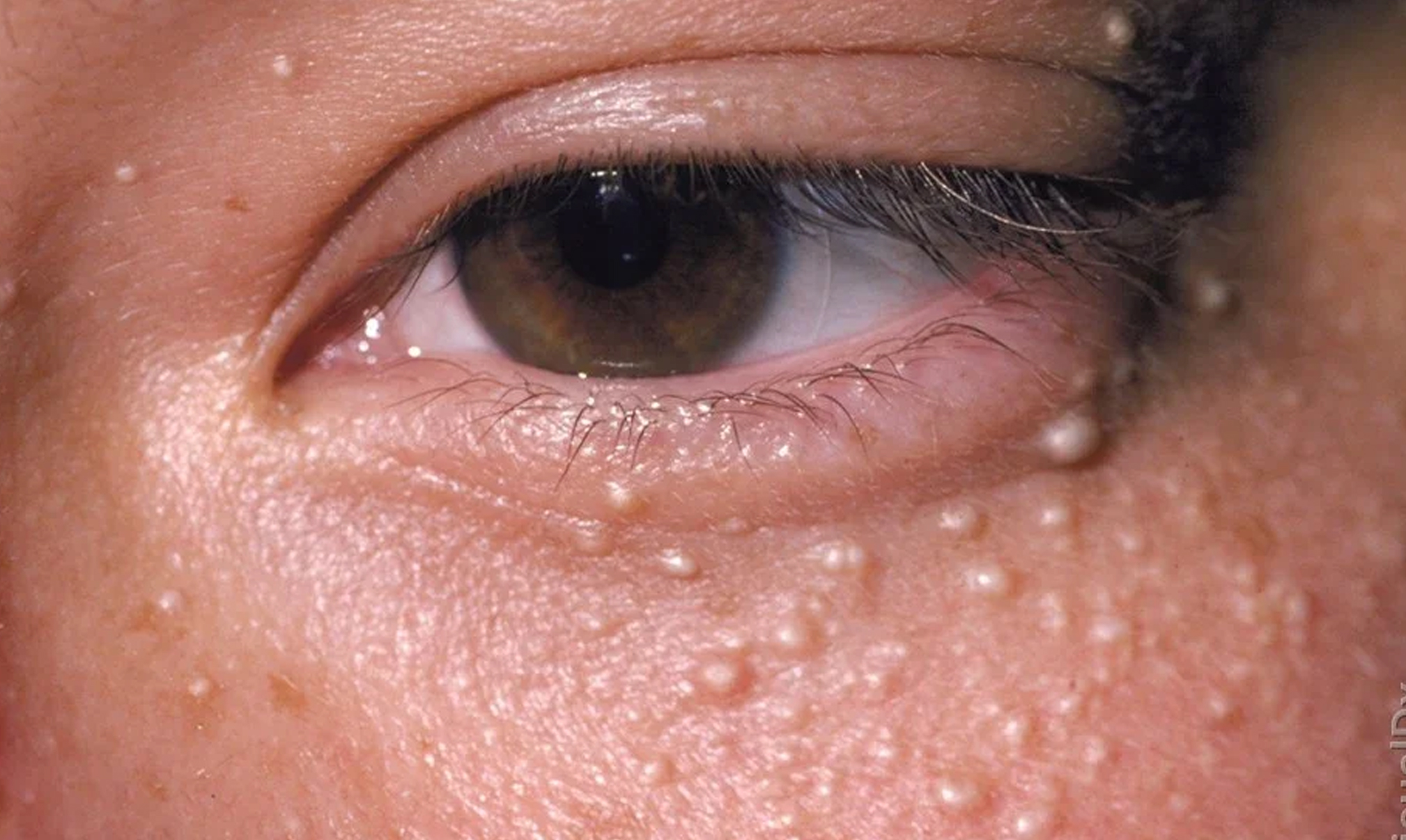 Milia Removal