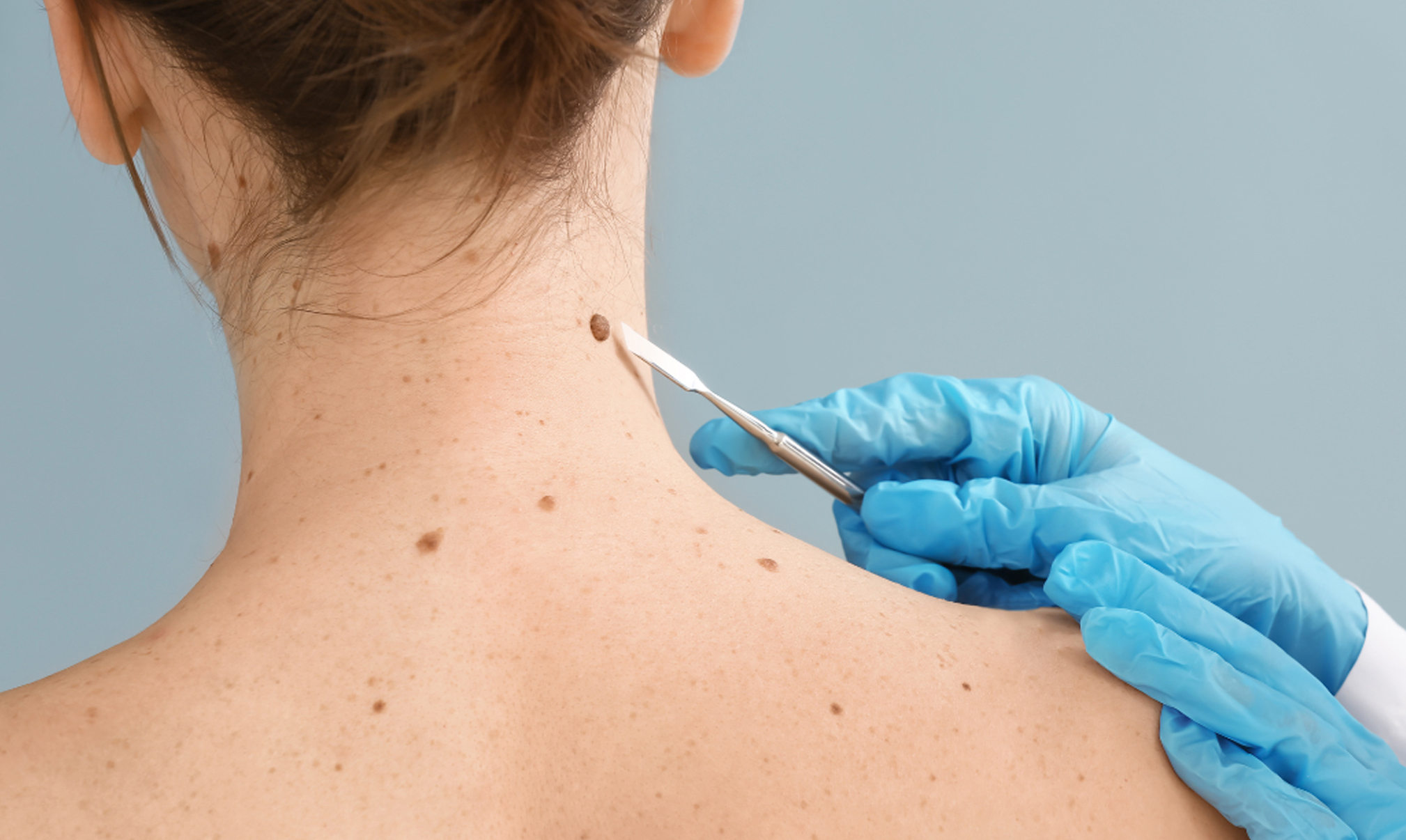 Wart/Mole Removal